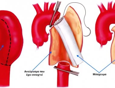 Ανεύρυσμα: 8 προειδοποιητικά σημάδια που δεν πρέπει ποτέ να αγνοήσετε